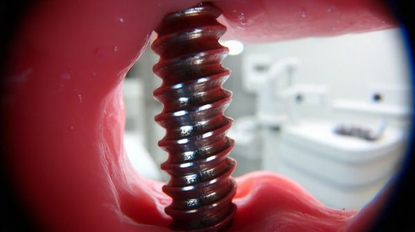 Les 10 complications des implants dentaires à connaître